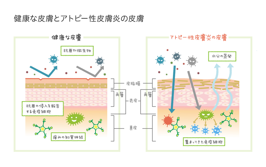 アトピー性皮膚炎