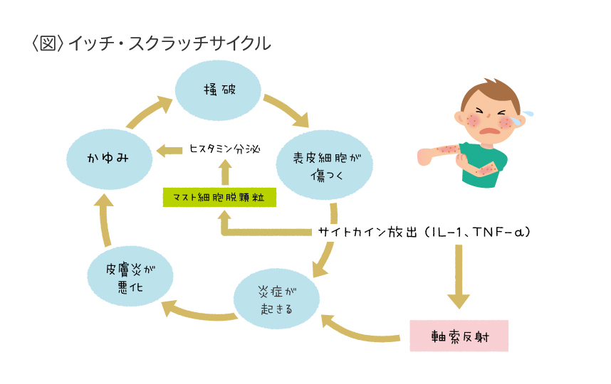 アトピー性皮膚炎