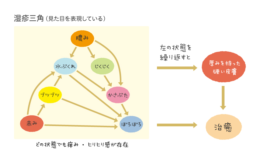 アトピー性皮膚炎