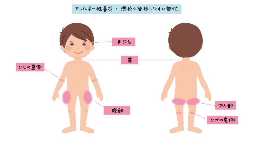 症状 ネズミ アレルギー