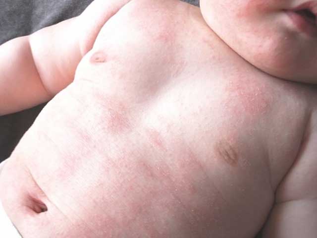 小児乾燥性湿疹